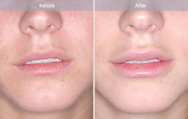 Tiêm filler làm dày môi và những dáng môi hot nhất năm 2018 các nàng cần cập nhật