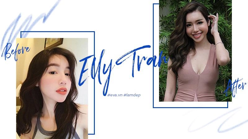 Tiêm filler xóa nhăn độn cằm tạo dáng mặt đang dần trở thành cơn sốt oanh tạc showbiz