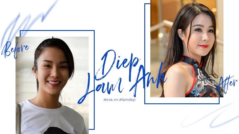 Tiêm filler xóa nhăn độn cằm tạo dáng mặt đang dần trở thành cơn sốt oanh tạc showbiz