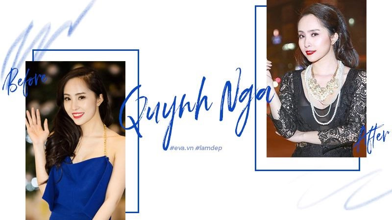 Tiêm filler xóa nhăn độn cằm tạo dáng mặt đang dần trở thành cơn sốt oanh tạc showbiz