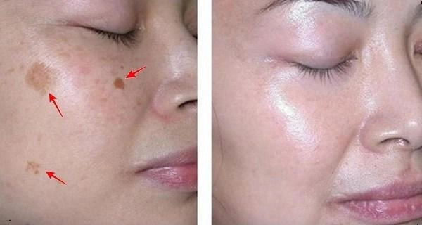 Trị nám da tại nhà đơn giản không ngờ chỉ với nguyên liệu rẻ tiền