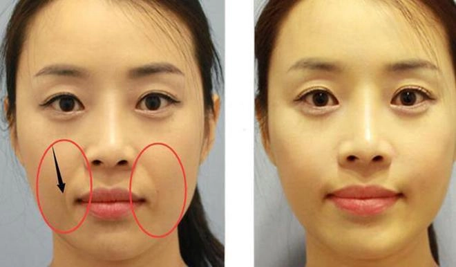 Từ u30 trở lên chị em không cần lo nếp nhăn khóe miệng nữa khi có những bí quyết này