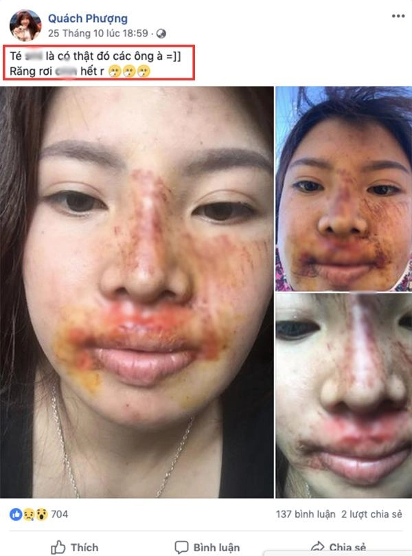 Từng đập đi xây lại cả khuôn mặt liệu đây có phải cái kết buồn cho phượng thị nở