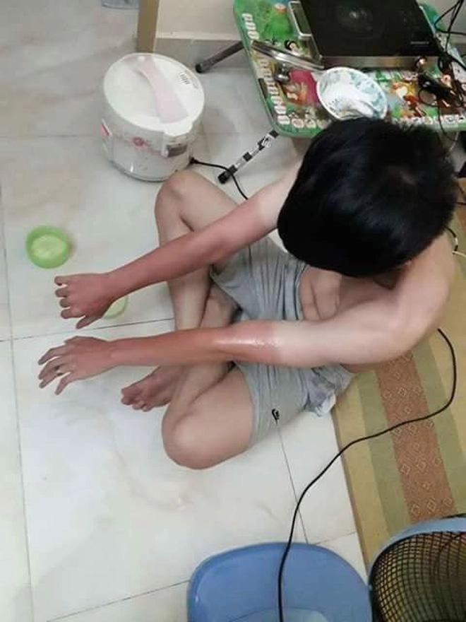 Tuyển tập ác mộng mùa hè dưỡng da cả một đời để rồi bị cháy nắng đến không thương tiếc