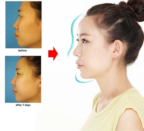 Xuất hiện với diện mạo khác lạ phải chăng lưu hương giang chạy theo trào lưu độn trán