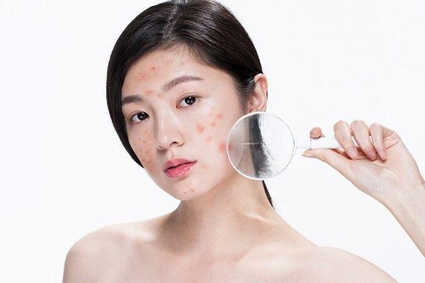 5 nguyên liệu là bài thuốc đánh bay mụn trên da không tốn tiền đi spa mà hiệu quả vượt trội