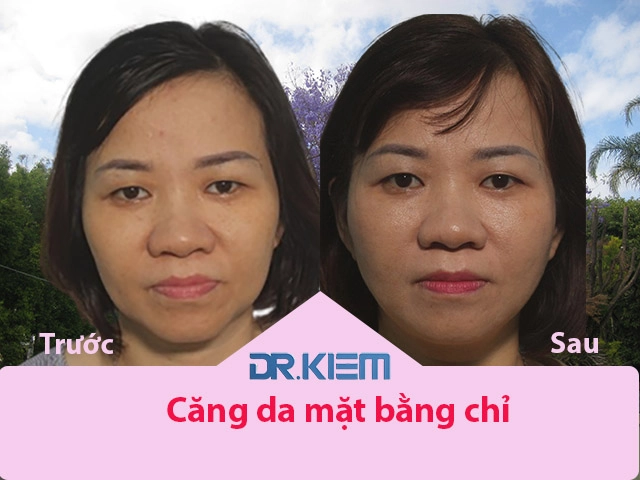 Bác sĩ thẩm mỹ cao kiêm chia sẻ bí quyết nâng cơ căng da mặt bằng chỉ