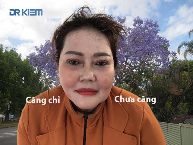 Bác sĩ thẩm mỹ cao kiêm chia sẻ bí quyết nâng cơ căng da mặt bằng chỉ
