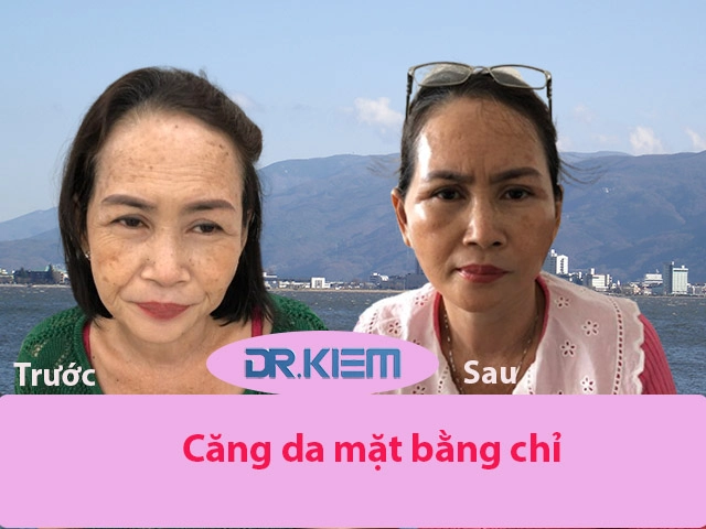 Bác sĩ thẩm mỹ cao kiêm chia sẻ bí quyết nâng cơ căng da mặt bằng chỉ