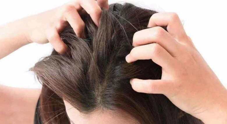 Bạn đã biết gội đầu đúng cách để giảm ngứa và gàu lời khuyên của bác sĩ da liễu gây bất ngờ