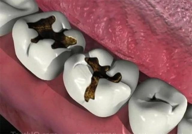 Bọc răng sứ và những điều cần biết để có bộ răng trắng đẹp