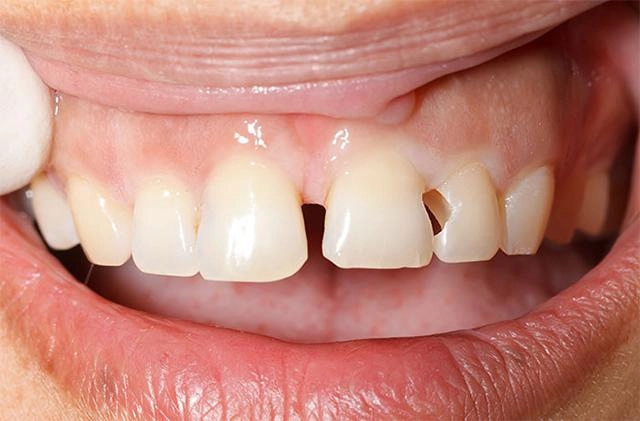 Bọc răng sứ và những điều cần biết để có bộ răng trắng đẹp