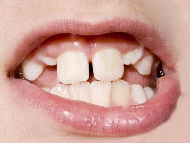 Bọc răng sứ và những điều cần biết để có bộ răng trắng đẹp