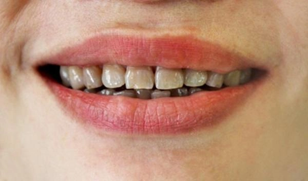 Bọc răng sứ và những điều cần biết để có bộ răng trắng đẹp