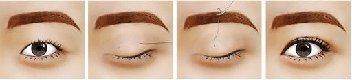 Cắt mí mắt và những kiến thức cần biết để tránh hậu quả khôn lường
