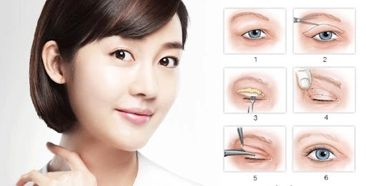 Cắt mí mắt và những kiến thức cần biết để tránh hậu quả khôn lường