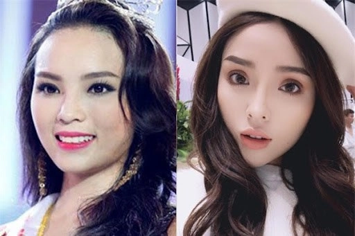 Cắt mí mắt và những kiến thức cần biết để tránh hậu quả khôn lường