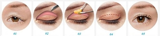 Cắt mí mắt và những kiến thức cần biết để tránh hậu quả khôn lường
