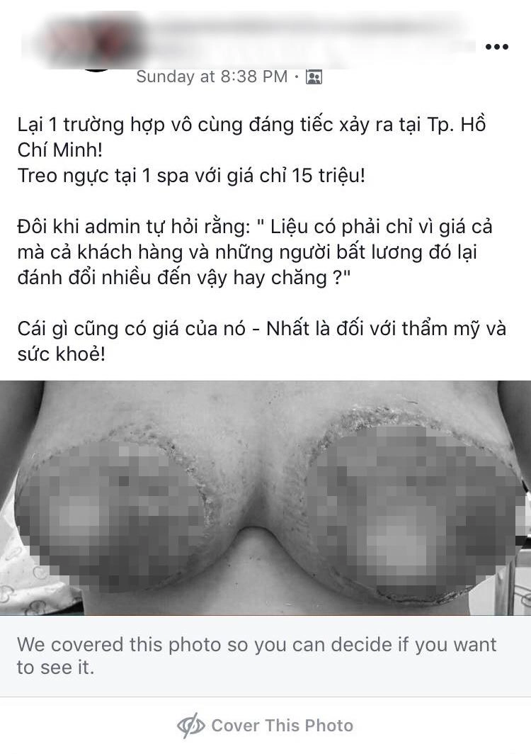 Chán nâng ngực giờ chị em còn treo ngực và đây là kết quả của màn treo ngực định mệnh