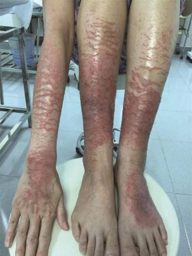 Đi tắm trắng cô gái khiến cả mạng xã hội hốt hoảng vì da trông như phỏng nặng