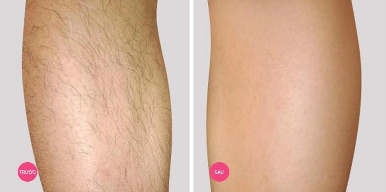 Hè rồi đi biển chẳng dám mặc bikini vì chân nhiều lông hãy áp dụng ngay 2 công thức này