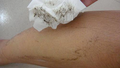 Hè rồi đi biển chẳng dám mặc bikini vì chân nhiều lông hãy áp dụng ngay 2 công thức này
