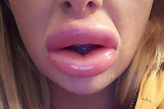 Khoe ảnh đẹp nhưng bị chê môi tều như mỏ vịt linh chi lập tức đáp trả gay gắt