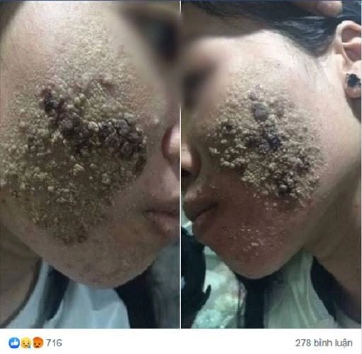 Khuôn mặt nổi từng mảng vì mê làm đẹp nhưng không rõ nguồn gốc cô gái khiến cđm xôn xao