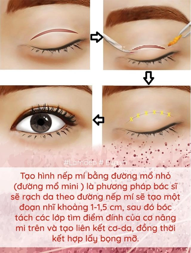Làm đẹp thế nào khi cứ mãi lẫn lộn nhấn mí với cắt mí đây là điều bạn cần biết