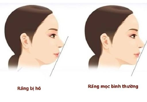 Ngỡ ngàng trước sự lột xác vi diệu nhờ niềng răng dung mạo thay đổi 180 độ