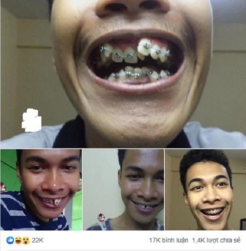 Ngỡ ngàng trước sự lột xác vi diệu nhờ niềng răng dung mạo thay đổi 180 độ