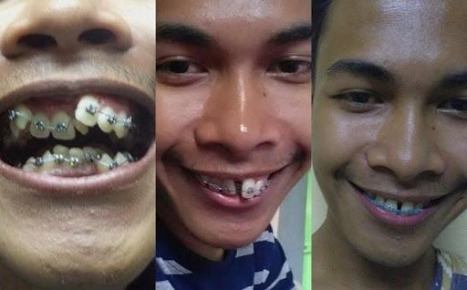 Ngỡ ngàng trước sự lột xác vi diệu nhờ niềng răng dung mạo thay đổi 180 độ