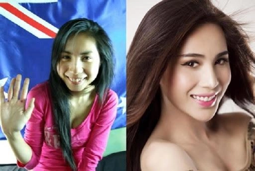 Ngỡ ngàng trước sự lột xác vi diệu nhờ niềng răng dung mạo thay đổi 180 độ