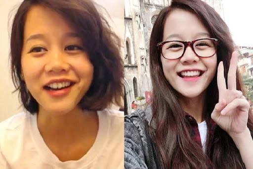 Ngỡ ngàng trước sự lột xác vi diệu nhờ niềng răng dung mạo thay đổi 180 độ