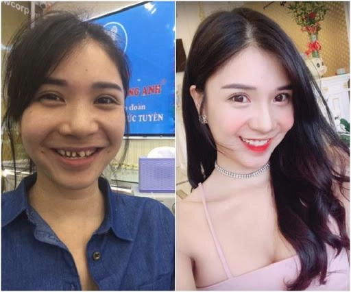Ngỡ ngàng trước sự lột xác vi diệu nhờ niềng răng dung mạo thay đổi 180 độ