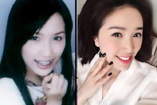 Ngỡ ngàng trước sự lột xác vi diệu nhờ niềng răng dung mạo thay đổi 180 độ