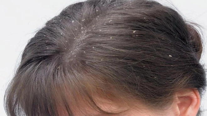Tóc xấu gãy rụng nhiều và có mùi là vì đâu