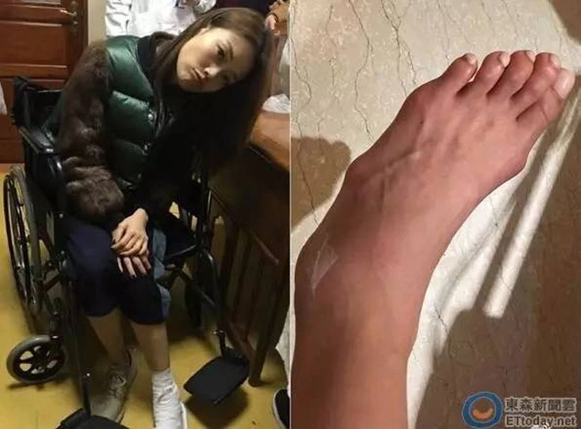 Siêu sao hoa ngữ biến dạng bàn chân vì sở thích đi giày cao gót quái chiêu